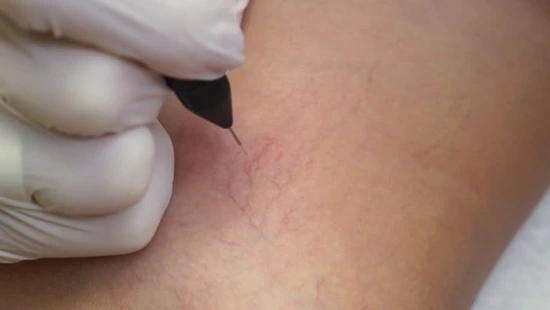 Лазерные методики коррекции сосудистых дефектов кожи 