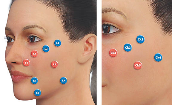 Фото 1.1. 8 точек лифтинга лица. Фото 1.2. Точки моделирования скуловой и щечной областей.
