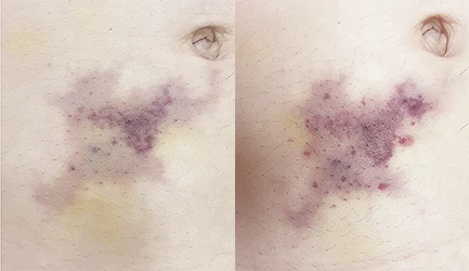 Почему появляются фиолетовые пятна на коже и как с ними бороться?