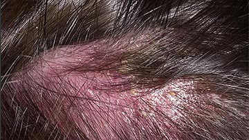 Дерматит раздраженный у пациента с чувствительной кожей головы
