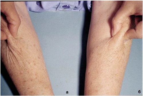  Терапия фотостарения кожи, женщина, 62 года: а - правая рука после 6 месяцев использования плацебо-лосьона; б - левая рука после 6 месяцев использования лосьона с 25% молочной кислоты