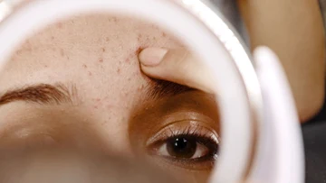 Причины позднего акне и ретиноевый пилинг и другие виды пилинга при acne tarda (акне тарда)